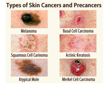 New skin cancer tool | Pharmacy Daily